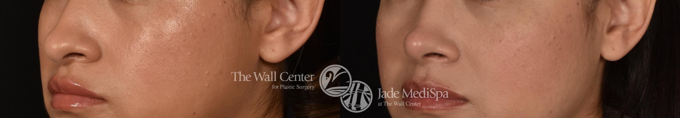 Before & After Rhinoplasty Case 1184 Left Oblique View in Shreveport, LA
