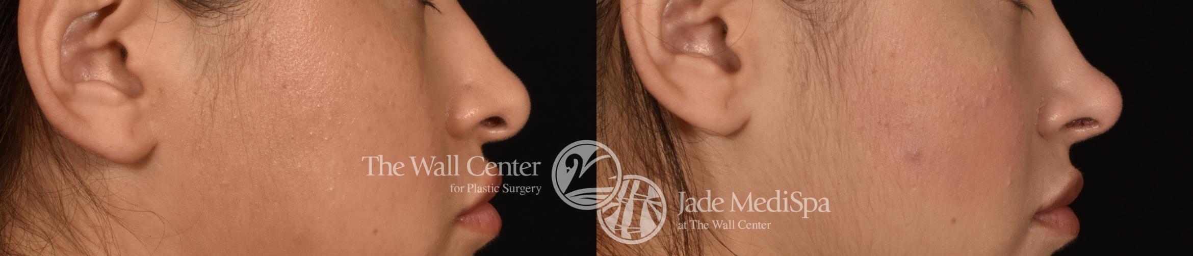 Before & After Rhinoplasty Case 1184 Right Side View in Shreveport, LA