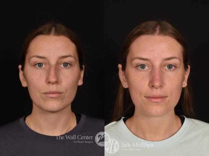 Before & After Rhinoplasty Case 1254 Front View in Shreveport, LA