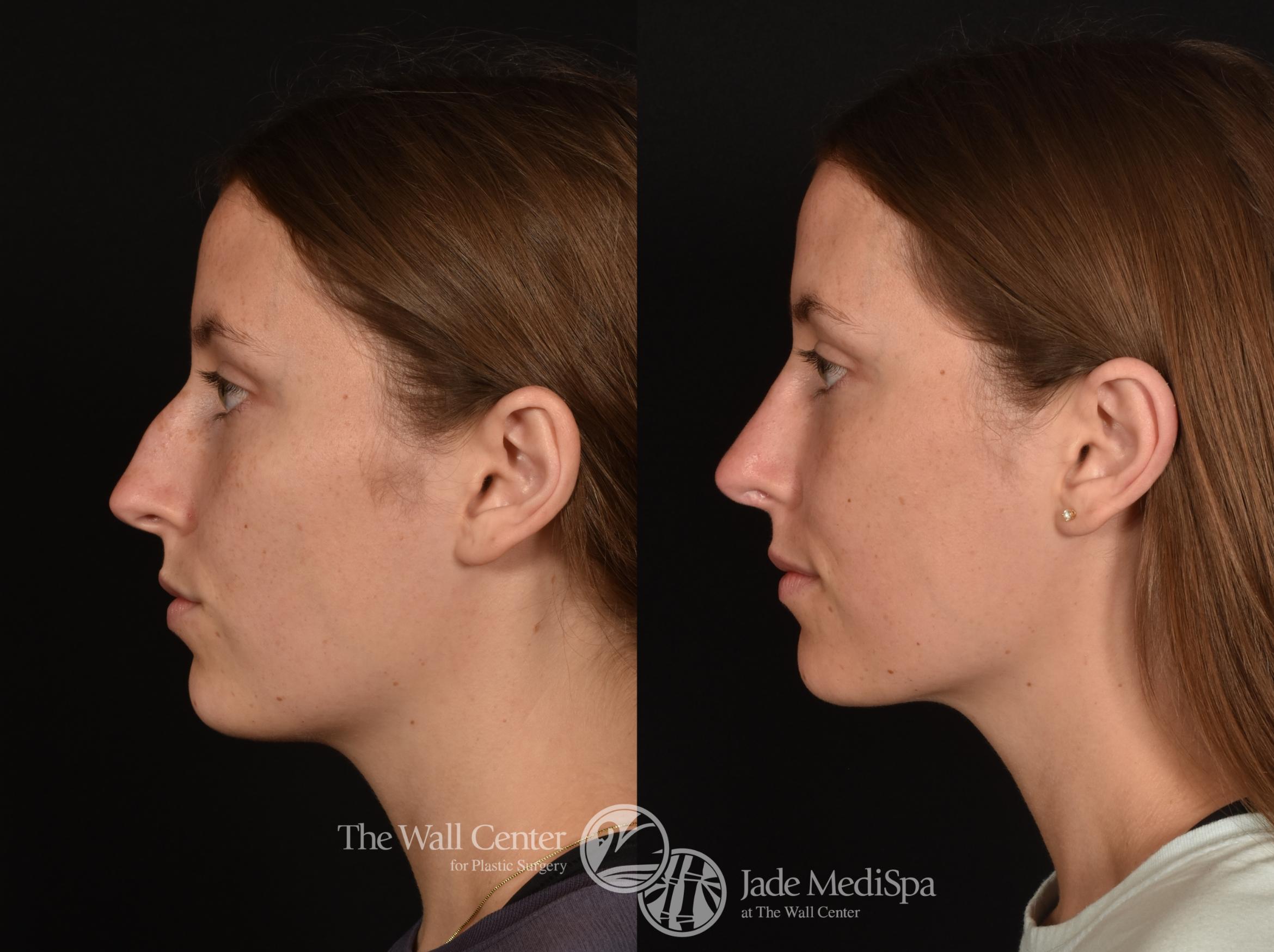 Before & After Rhinoplasty Case 1254 Left Side View in Shreveport, LA