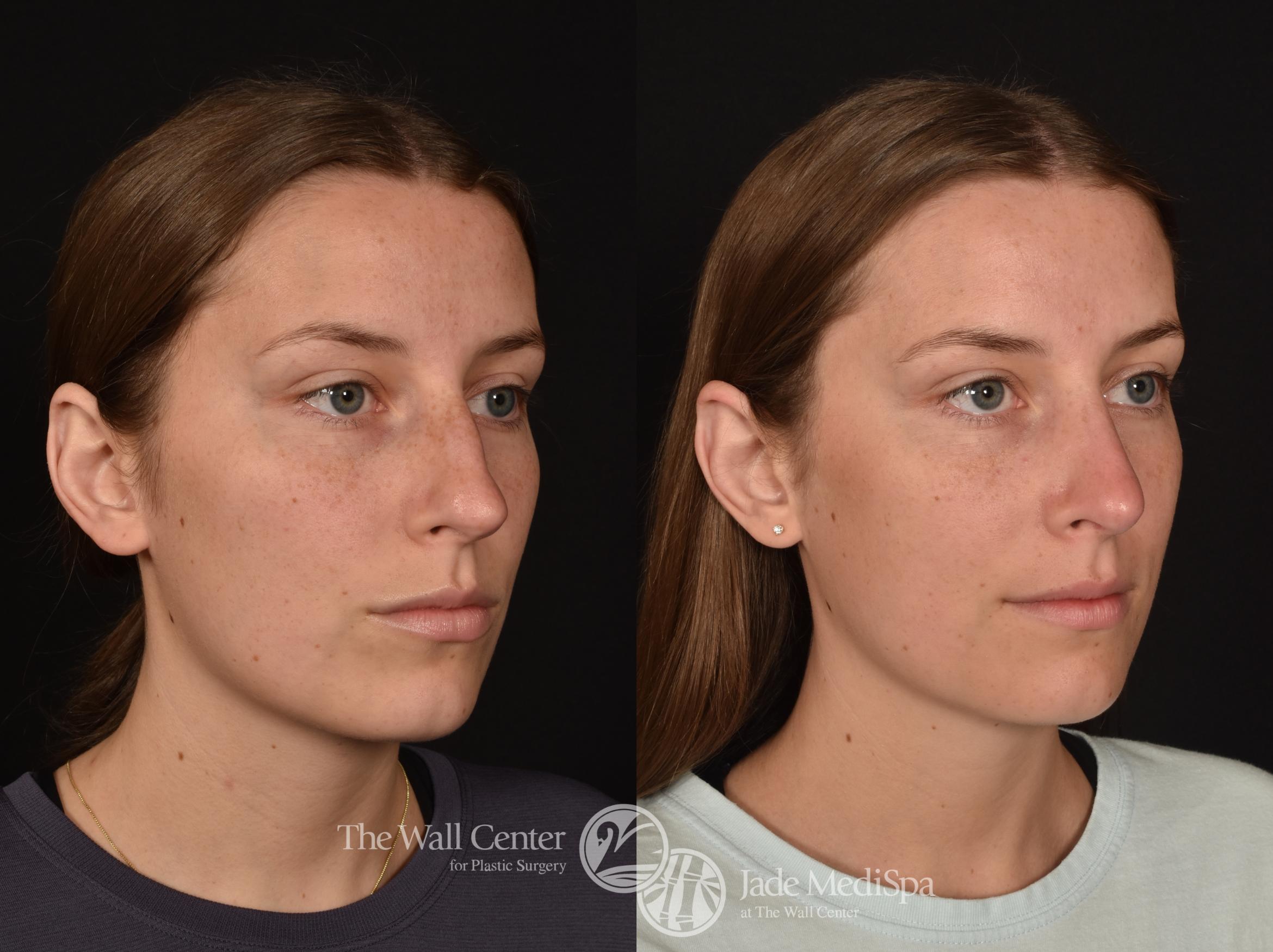 Before & After Rhinoplasty Case 1254 Right Oblique View in Shreveport, LA