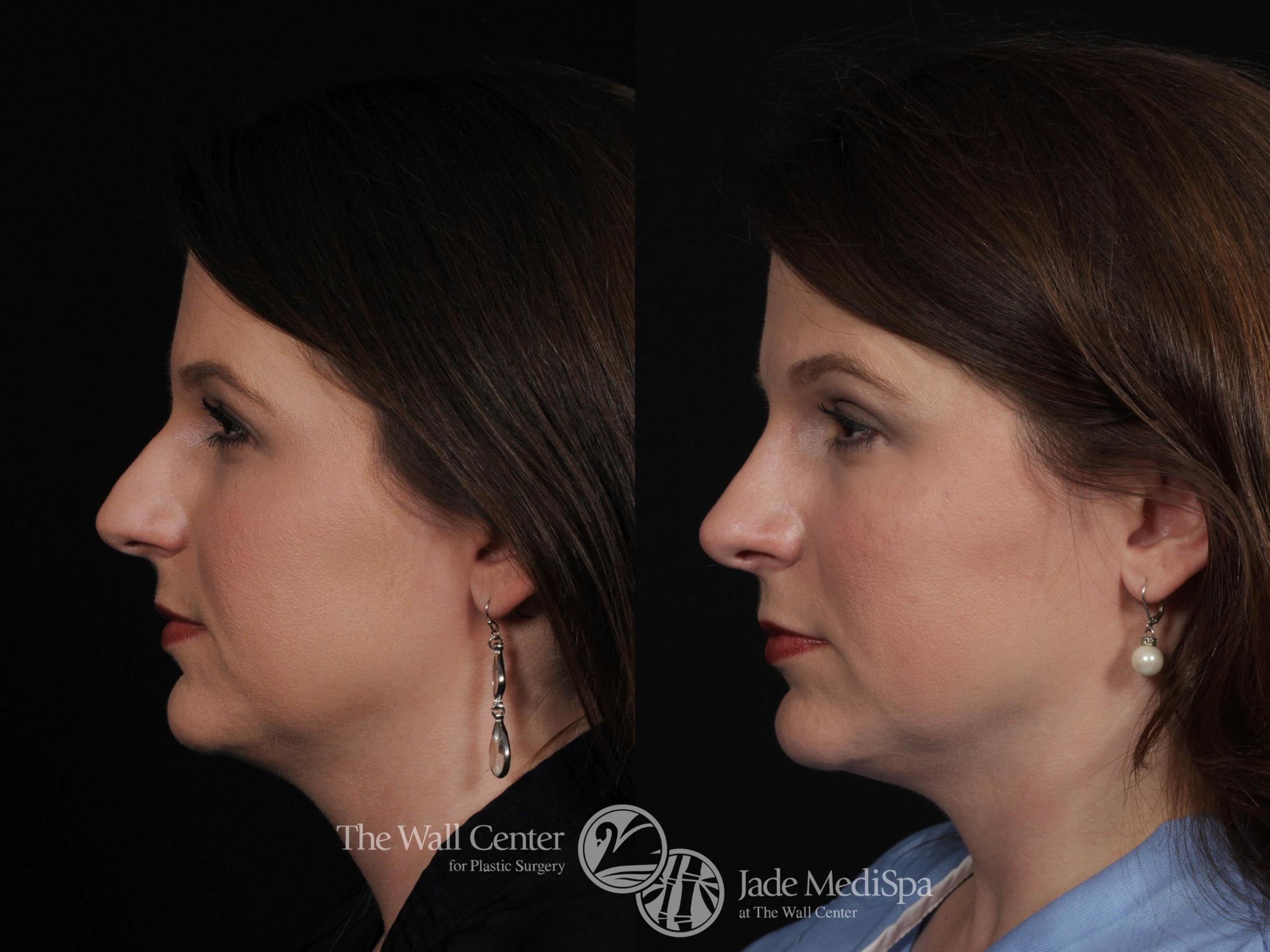 Before & After Rhinoplasty Case 554 View #1 View in Shreveport, LA