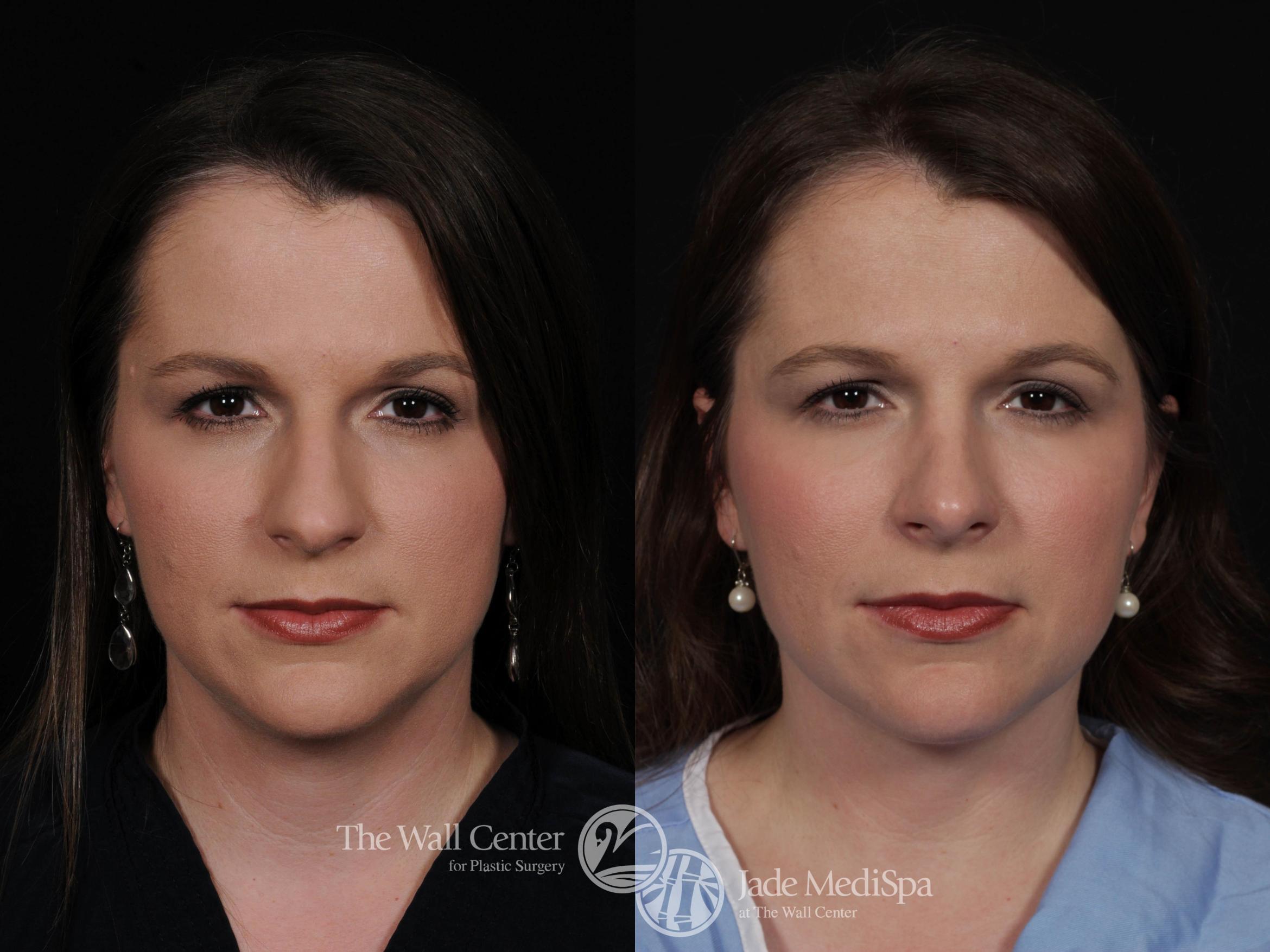 Before & After Rhinoplasty Case 554 View #2 View in Shreveport, LA