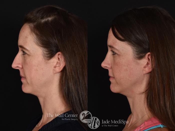 Before & After Rhinoplasty Case 612 View #1 View in Shreveport, LA