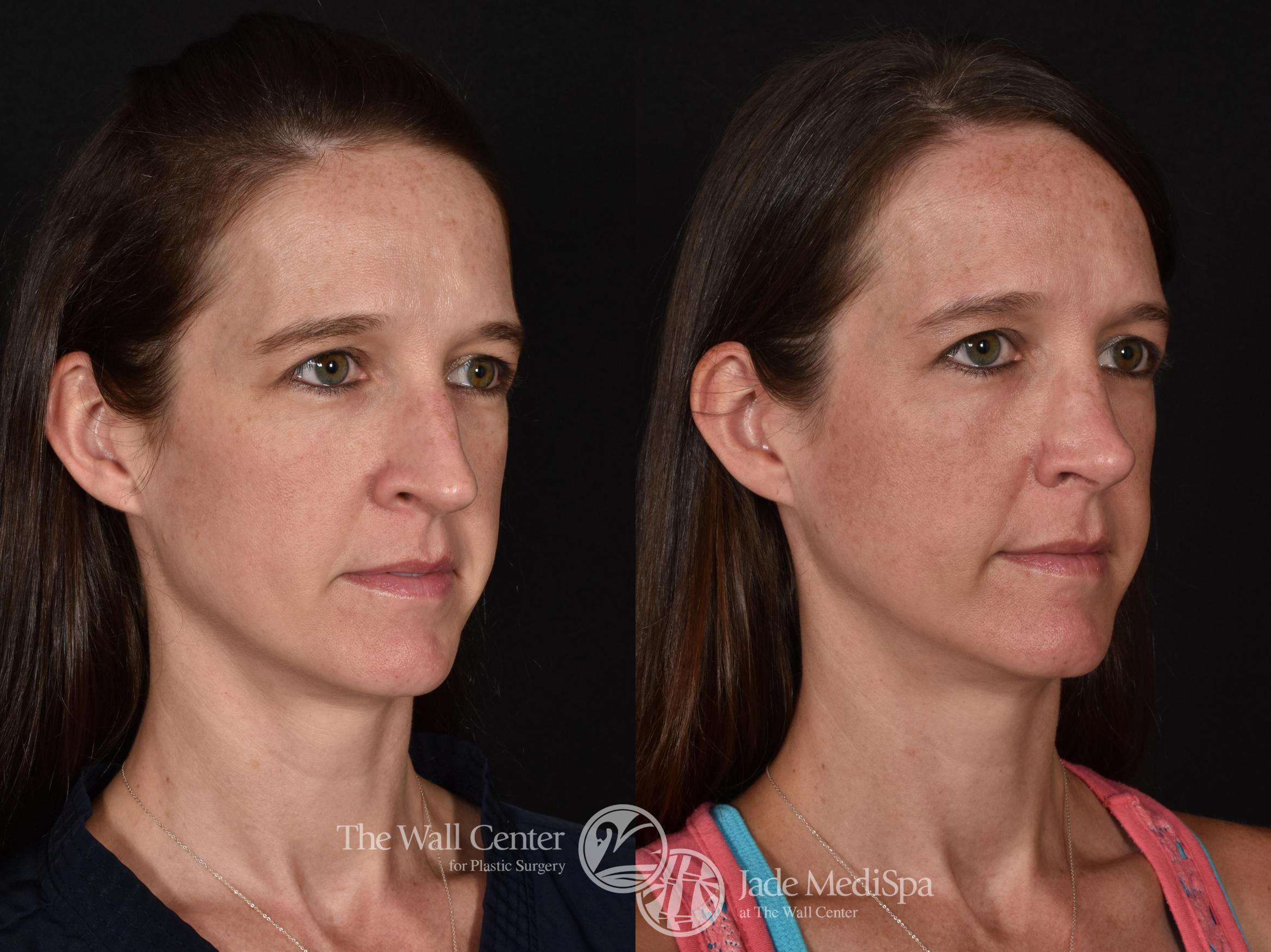 Before & After Rhinoplasty Case 612 View #2 View in Shreveport, LA