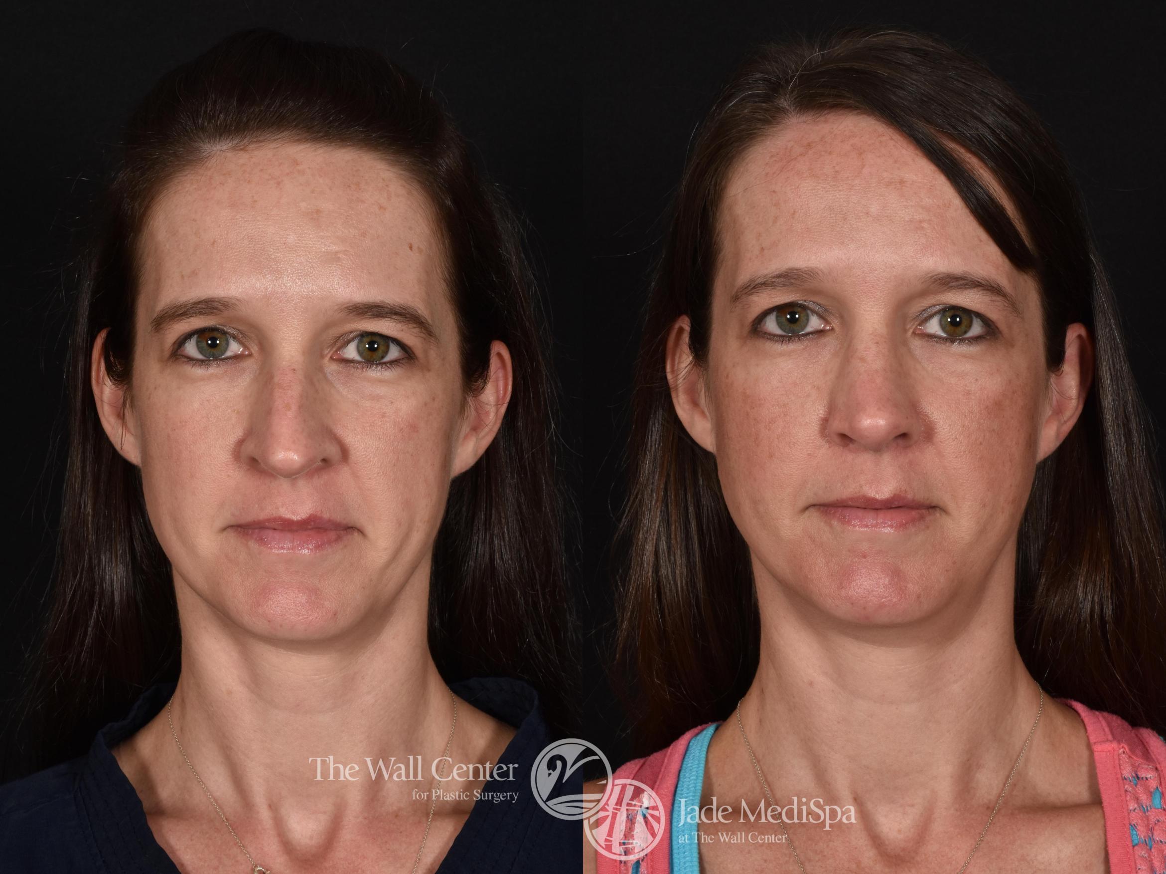 Before & After Rhinoplasty Case 612 View #3 View in Shreveport, LA