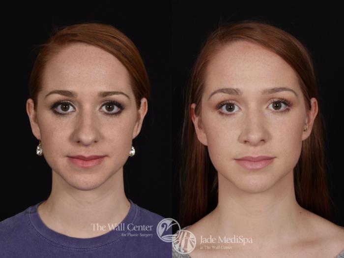 Before & After Rhinoplasty Case 685 VIEW #1 View in Shreveport, LA