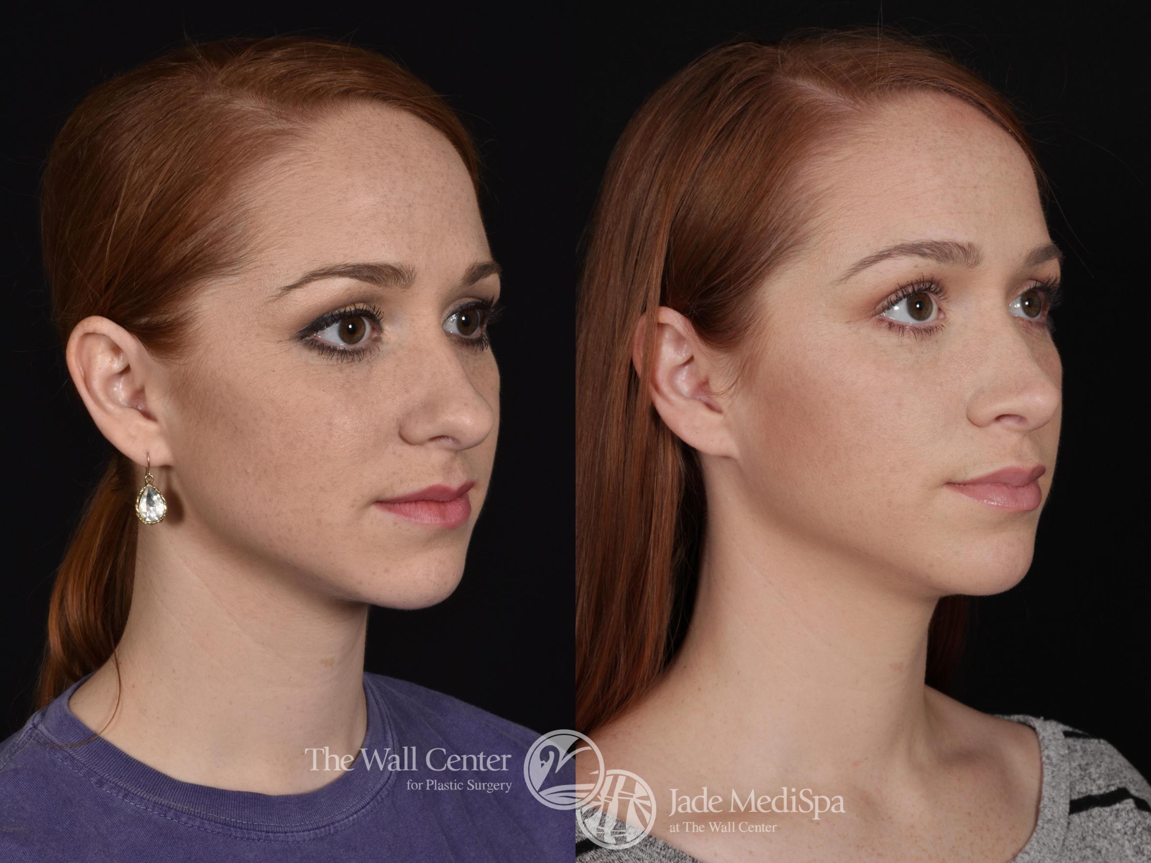 Before & After Rhinoplasty Case 685 VIEW #2 View in Shreveport, LA