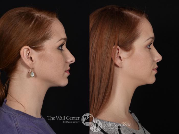 Before & After Rhinoplasty Case 685 VIEW #3 View in Shreveport, LA