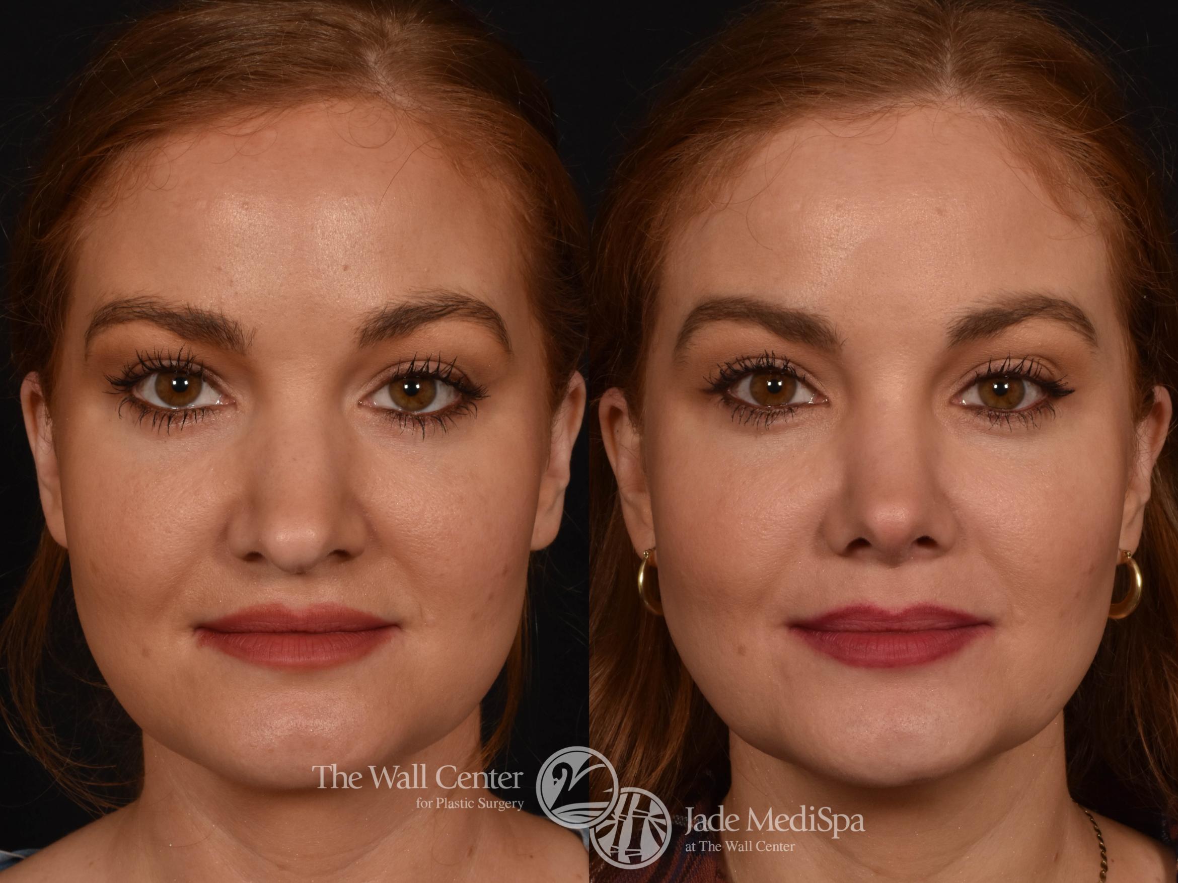 Before & After Rhinoplasty Case 995 Front View in Shreveport, LA