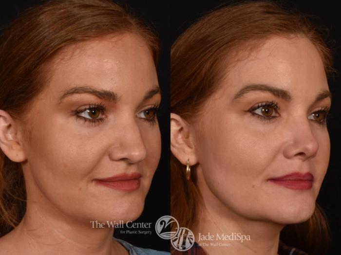 Before & After Rhinoplasty Case 995 Right Oblique View in Shreveport, LA
