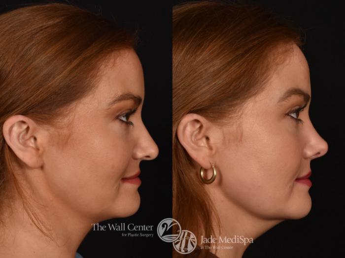 Before & After Rhinoplasty Case 995 Right Side View in Shreveport, LA