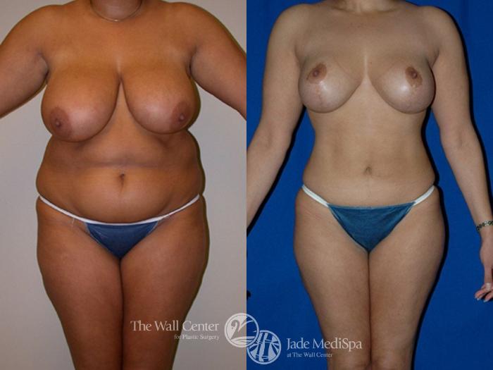 Before & After Breast Lift Case 1 View #1 View in Shreveport, LA