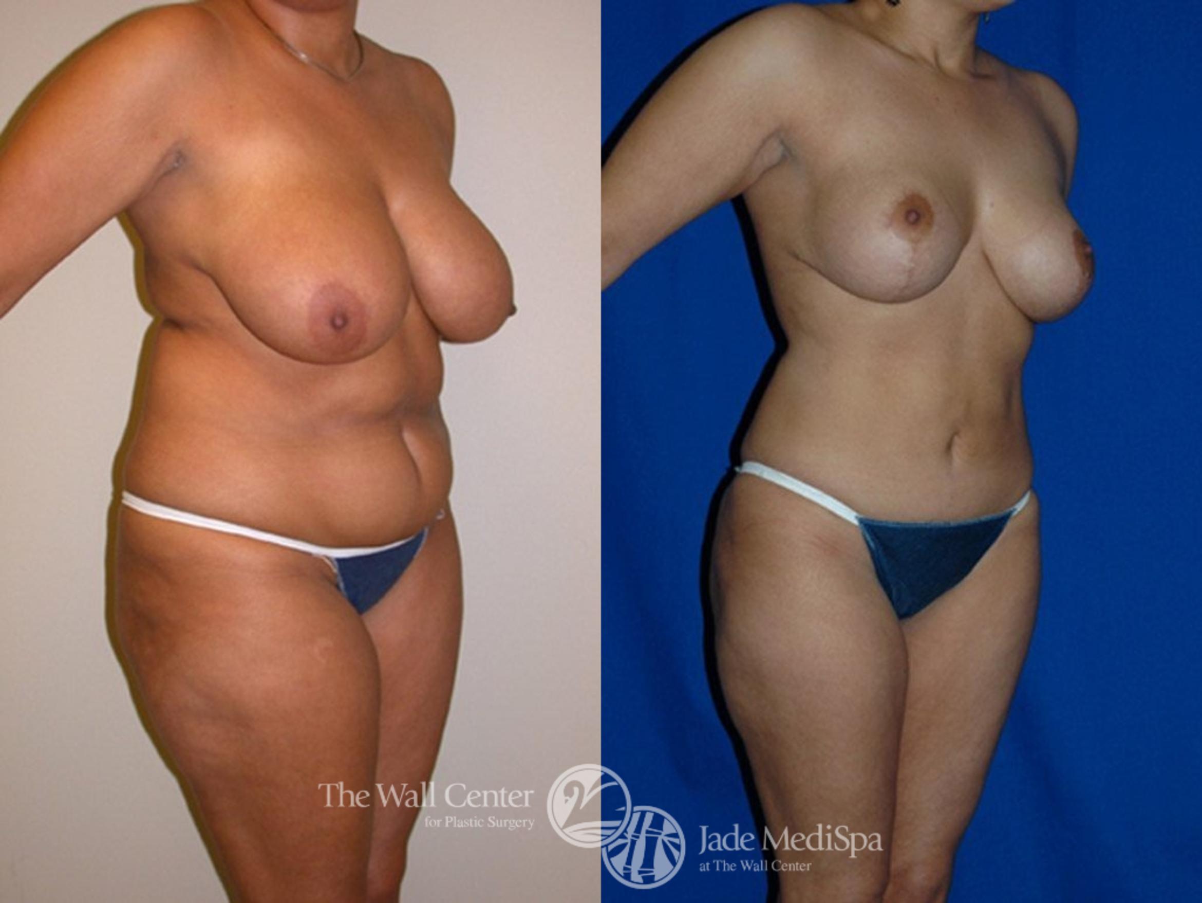 Before & After Breast Lift Case 1 View #2 View in Shreveport, LA