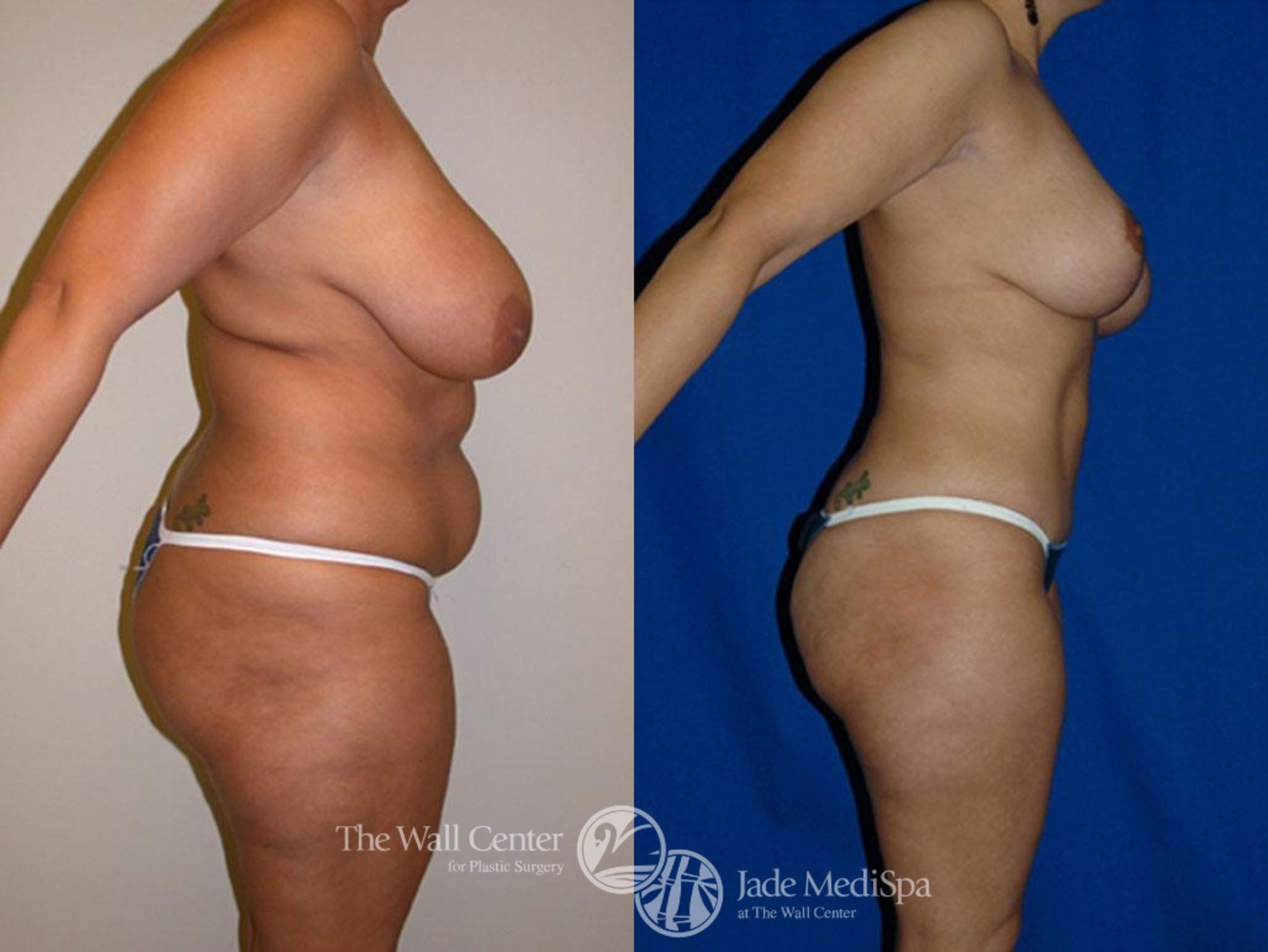 Before & After Breast Lift Case 1 View #3 View in Shreveport, LA