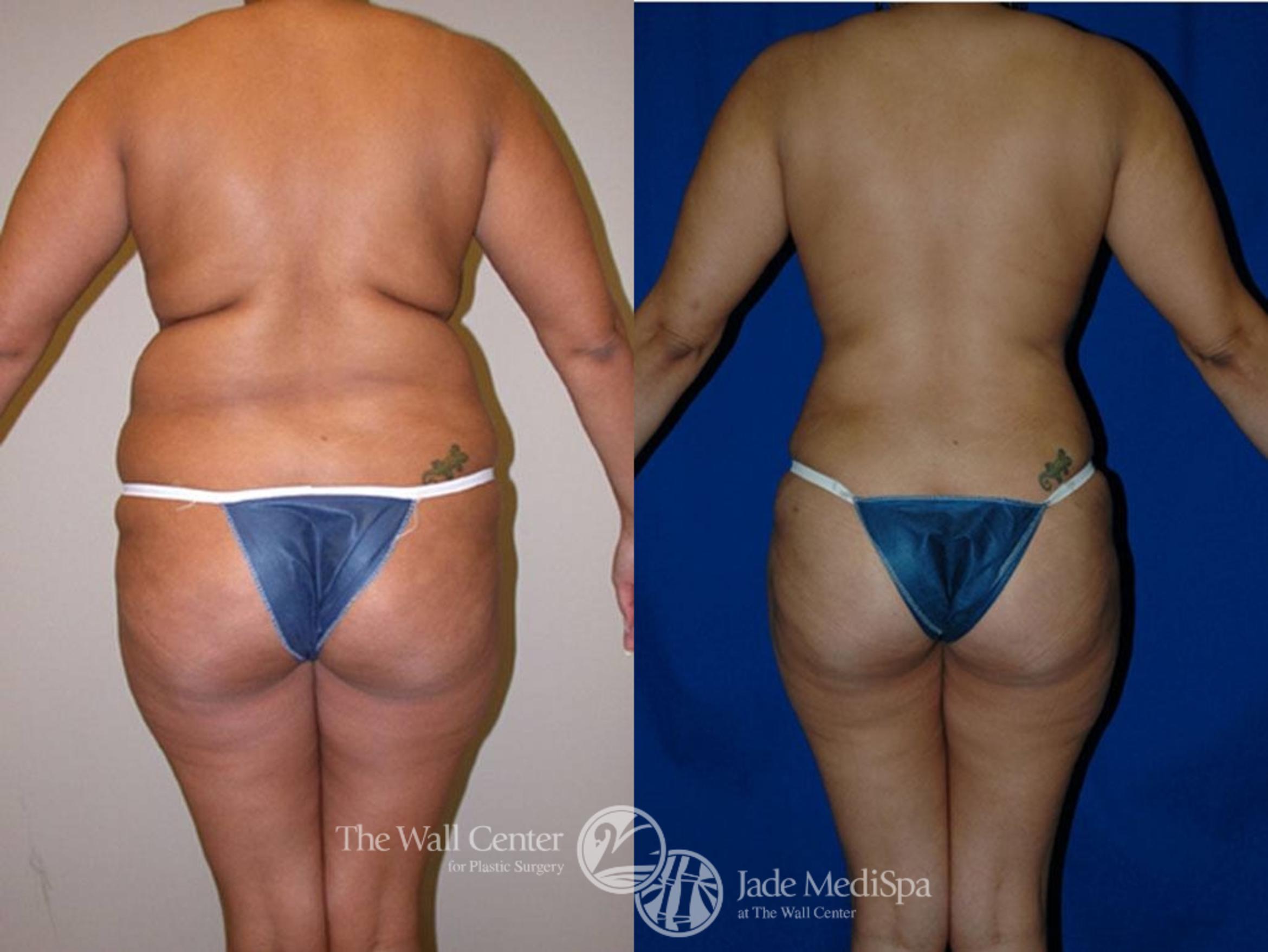 Before & After Breast Lift Case 1 View #4 View in Shreveport, LA