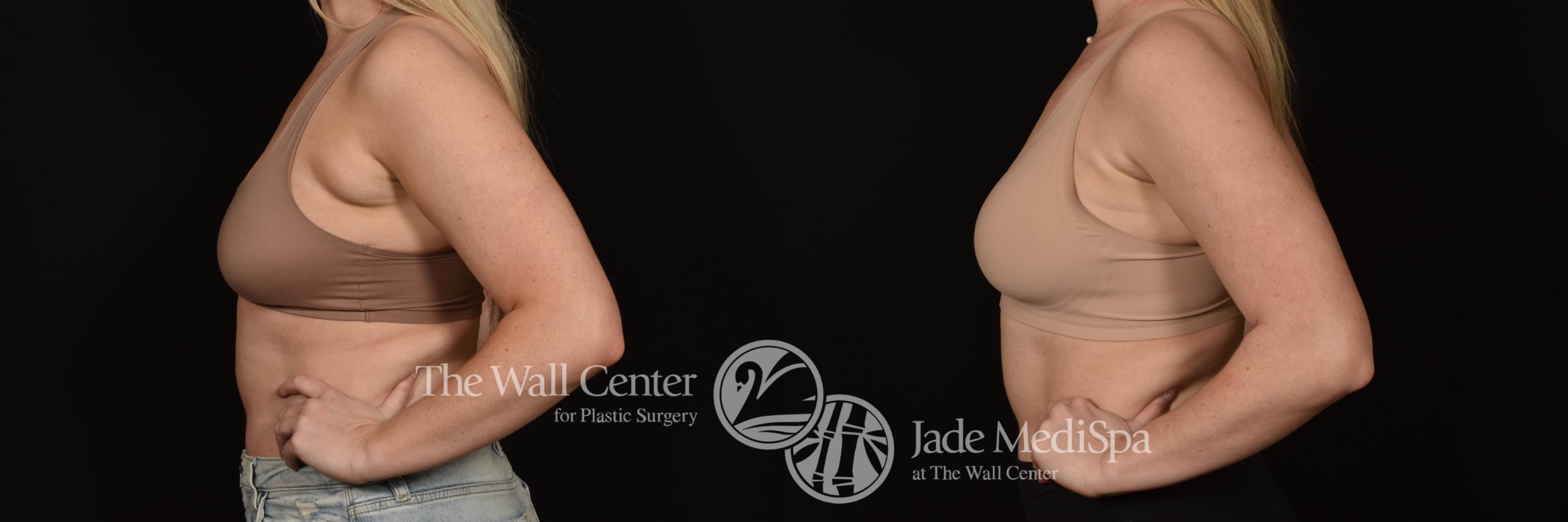 Before & After SAFELipo™ Case 1080 Left Side View in Shreveport, LA