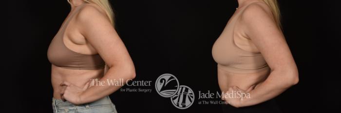 Before & After SAFELipo™ Case 1080 Left Side View in Shreveport, LA