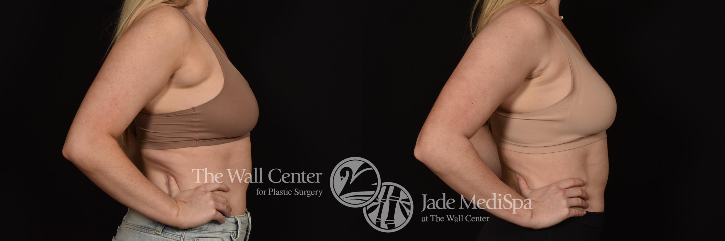 Before & After SAFELipo™ Case 1080 Right Side View in Shreveport, LA