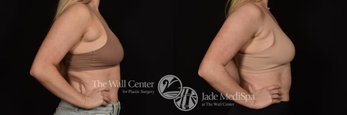 Before & After SAFELipo™ Case 1080 Right Side View in Shreveport, LA