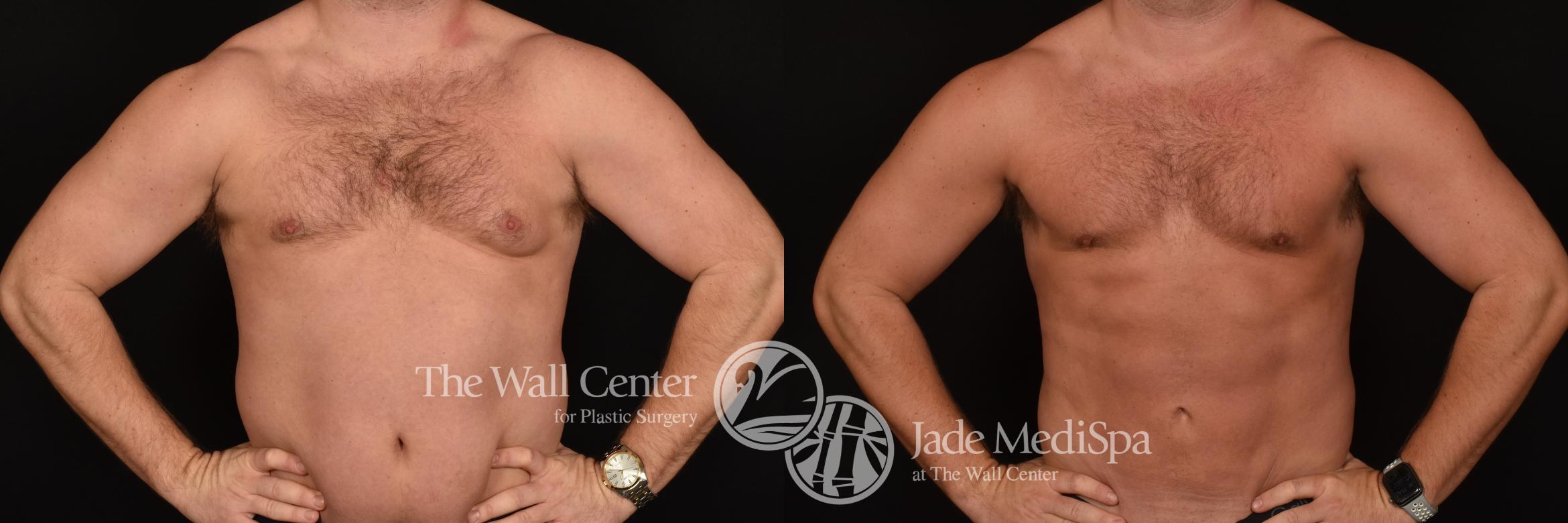 Before & After SAFELipo™ Case 1264 Front View in Shreveport, LA