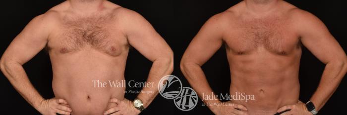 Before & After SAFELipo™ Case 1264 Front View in Shreveport, LA