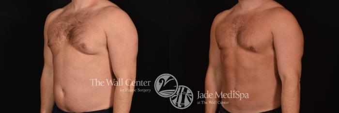 Before & After SAFELipo™ Case 1264 Left Oblique View in Shreveport, LA