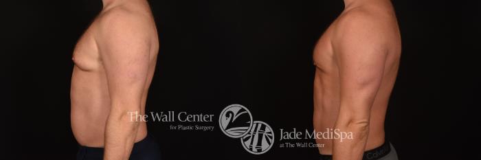 Before & After SAFELipo™ Case 1264 Left Side View in Shreveport, LA