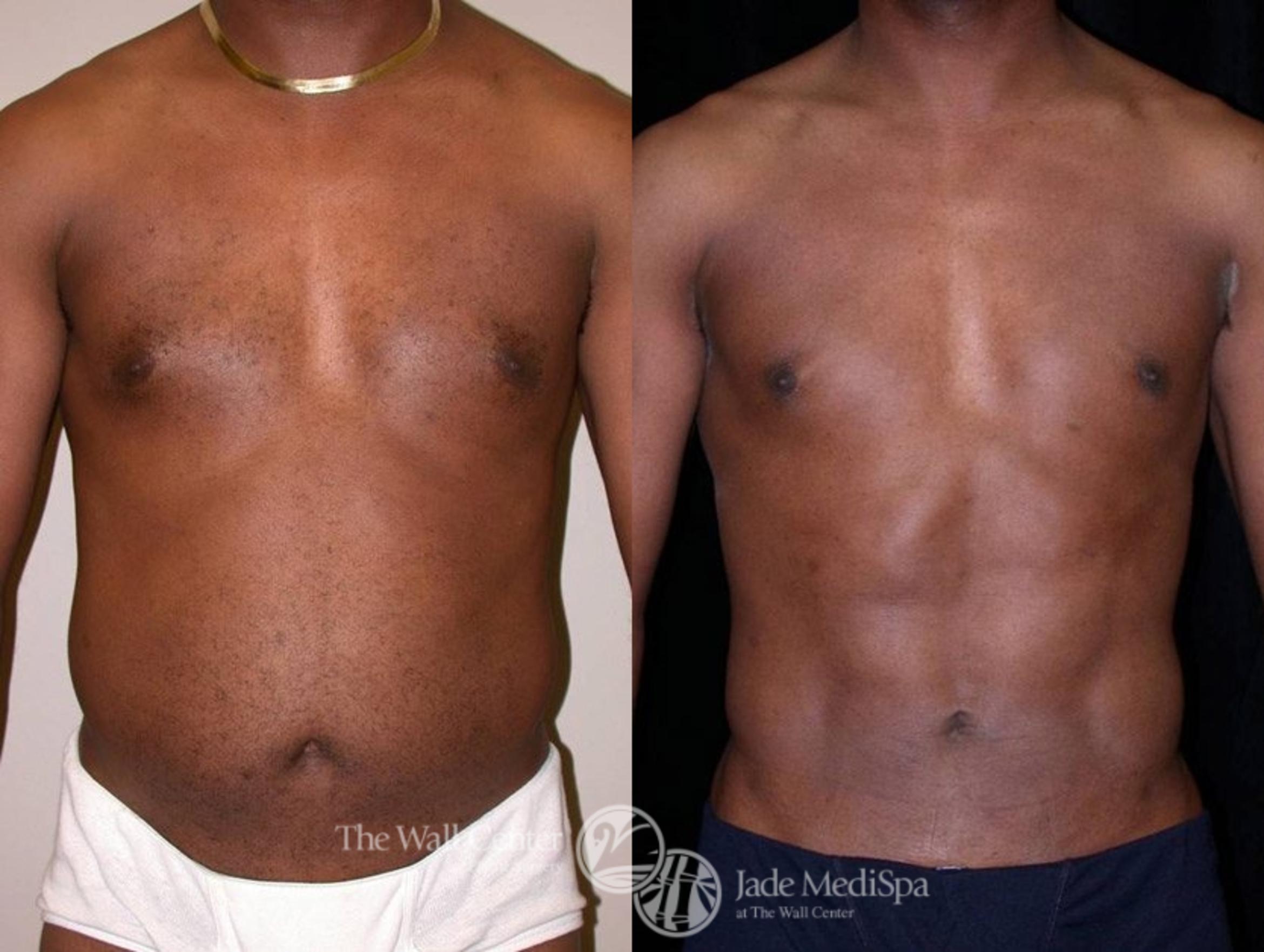 Before & After Male Breast Reduction Case 13 View #1 View in Shreveport, LA