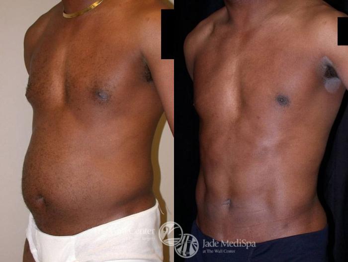 Before & After Male Breast Reduction Case 13 View #2 View in Shreveport, LA