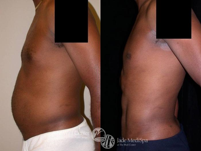 Before & After Male Breast Reduction Case 13 View #3 View in Shreveport, LA