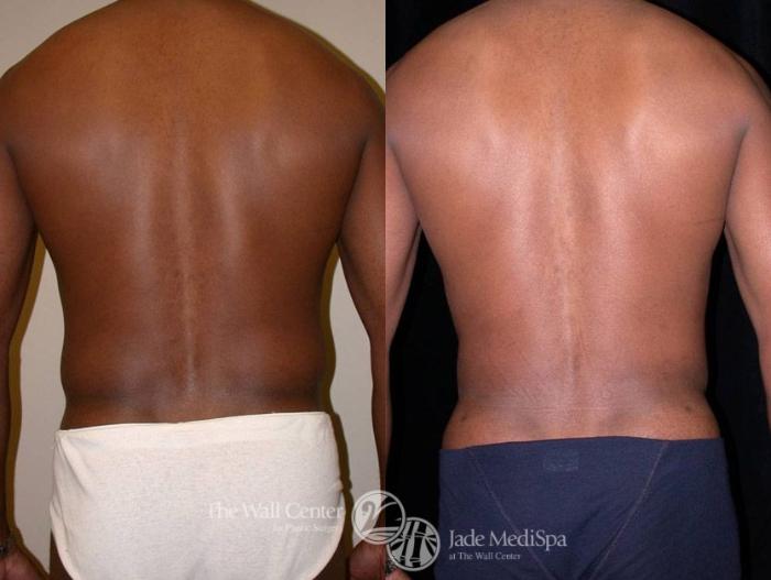 Before & After Male Breast Reduction Case 13 View #4 View in Shreveport, LA