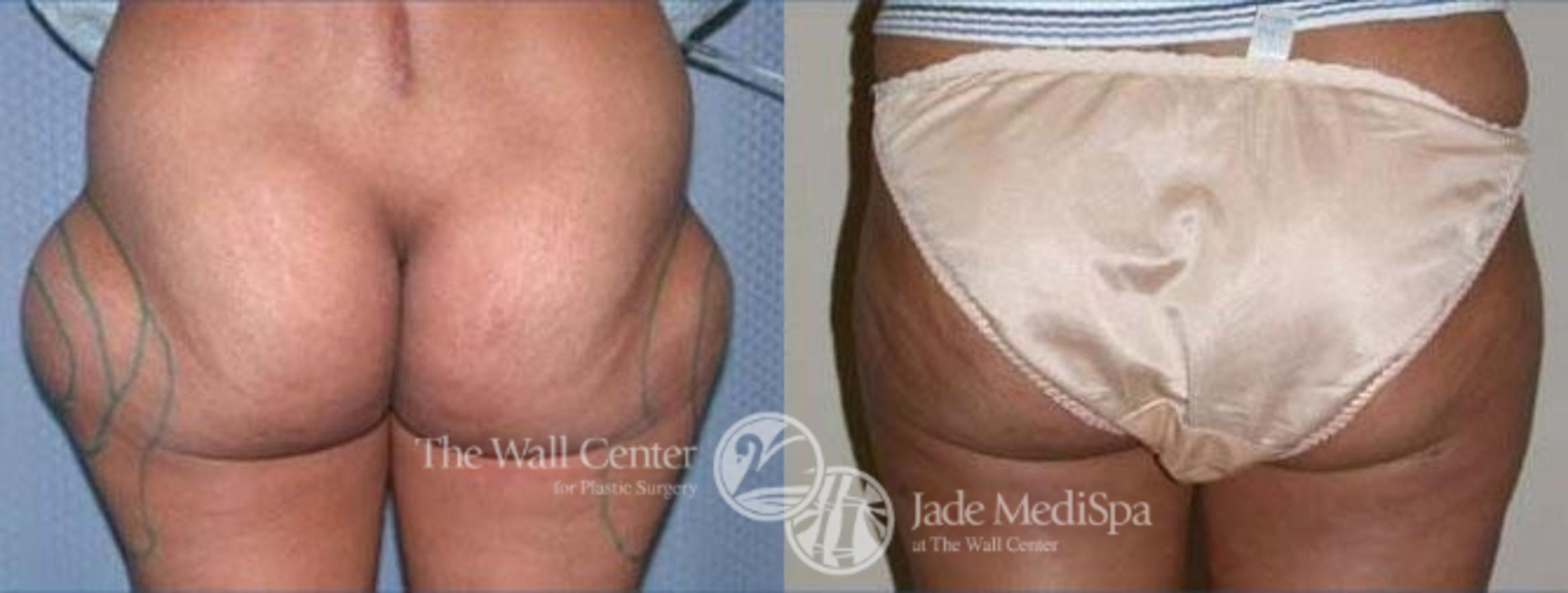 Before & After SAFELipo™ Case 142 View #3 View in Shreveport, LA