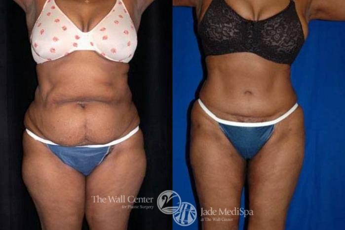 Before & After Tummy Tuck Case 144 View #1 View in Shreveport, LA