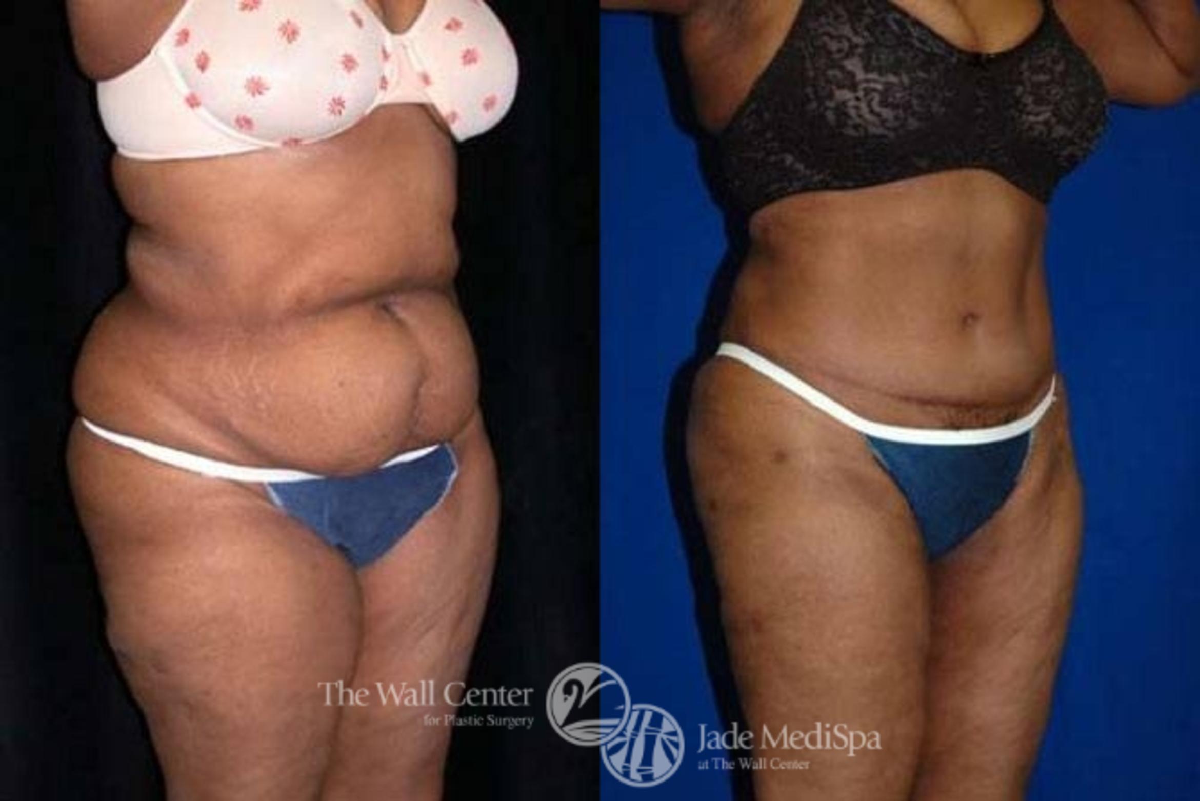 Before & After Tummy Tuck Case 144 View #2 View in Shreveport, LA