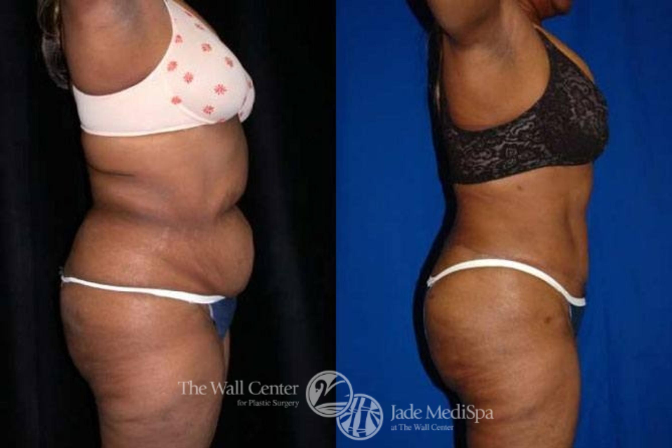 Before & After Tummy Tuck Case 144 View #3 View in Shreveport, LA