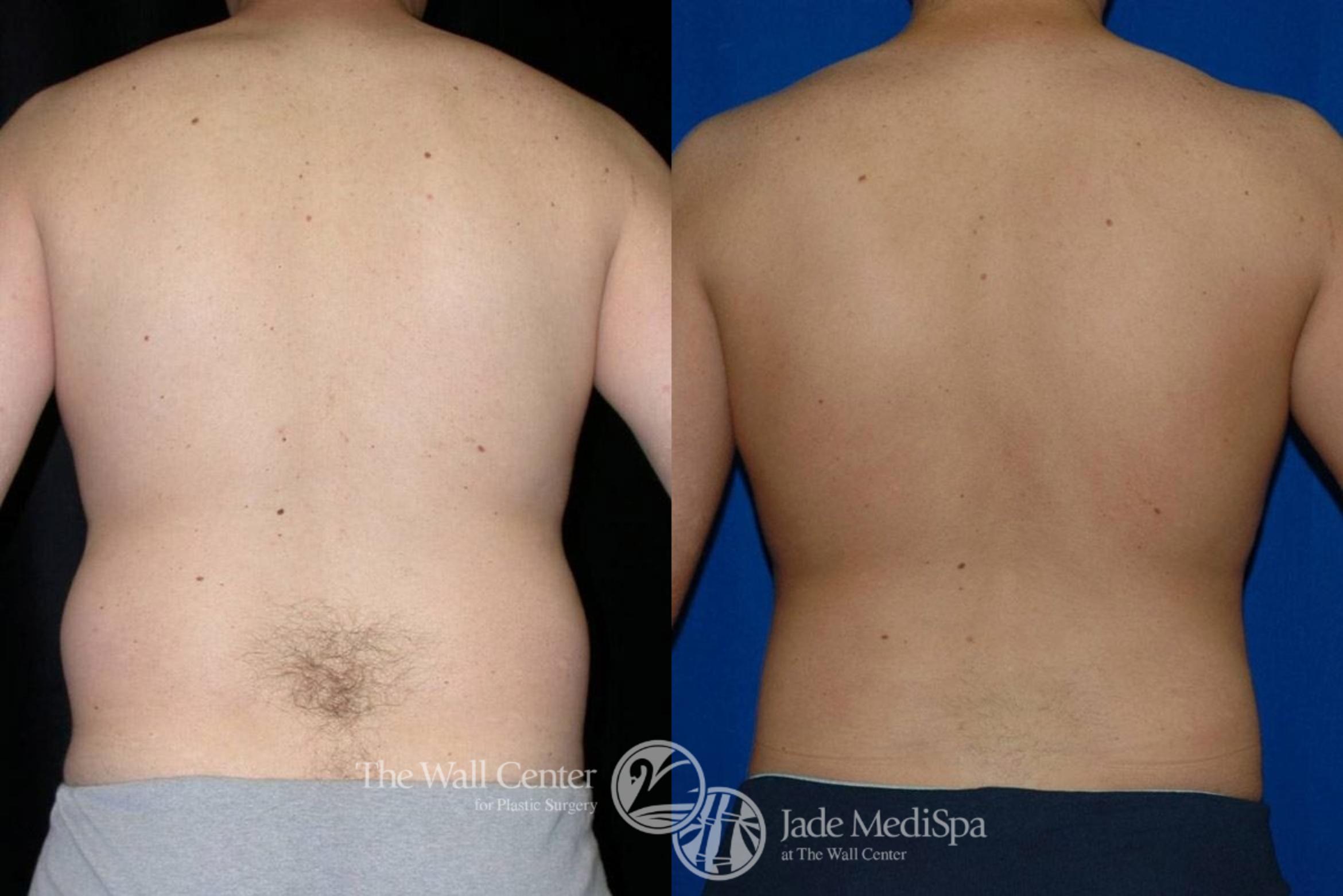 Before & After SAFELipo™ Case 15 View #4 View in Shreveport, LA