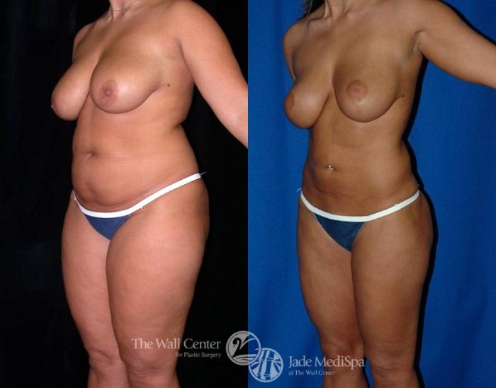Before & After SAFELipo™ Case 2 View #2 View in Shreveport, LA