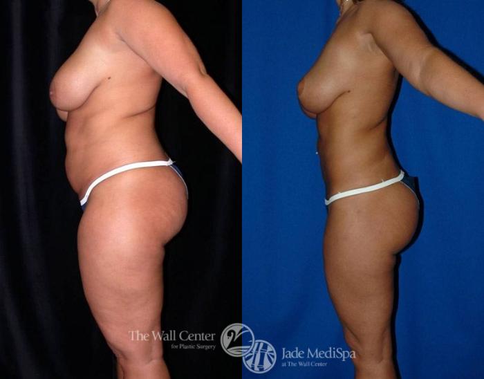 Before & After SAFELipo™ Case 2 View #3 View in Shreveport, LA