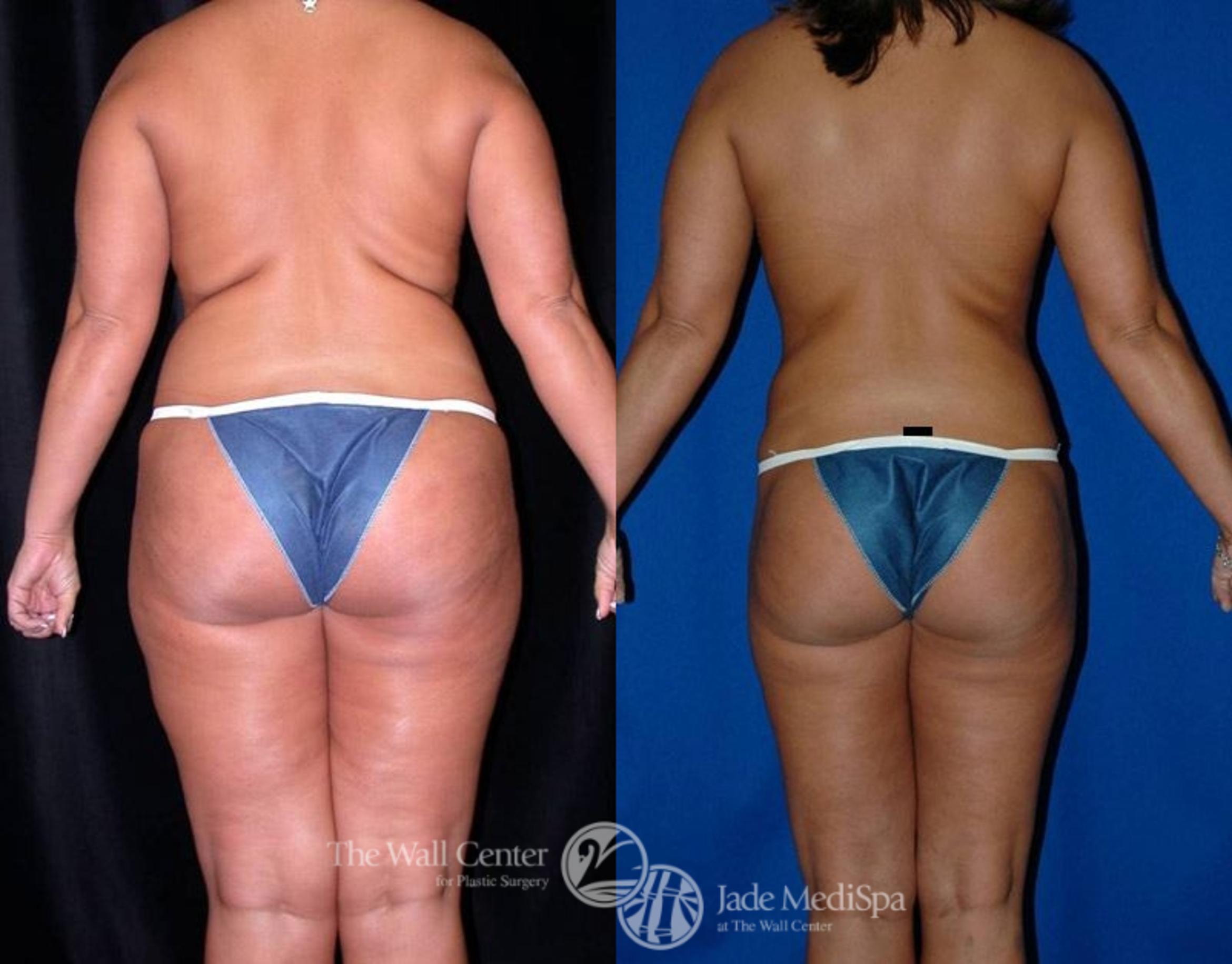 Before & After SAFELipo™ Case 2 View #4 View in Shreveport, LA