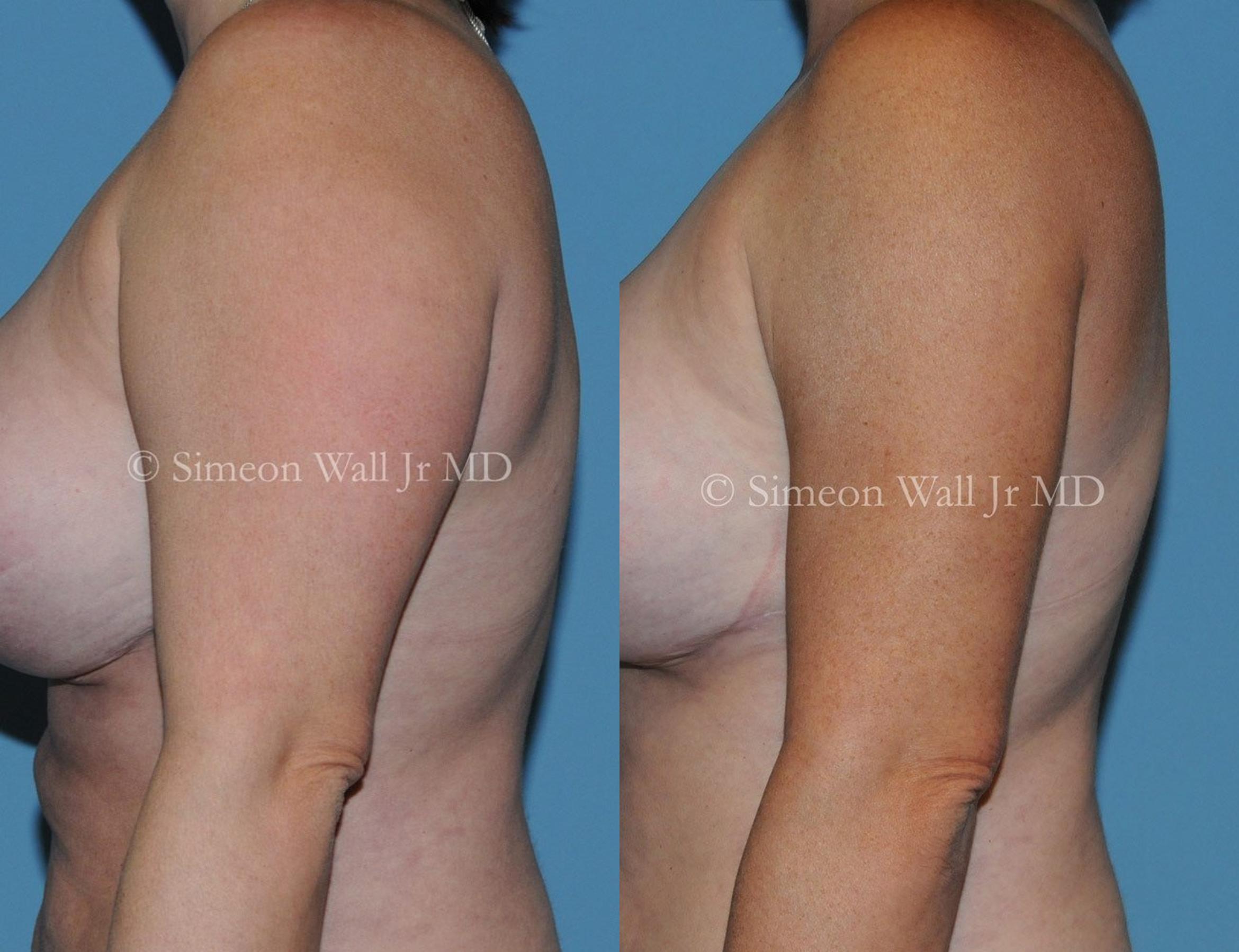 Before & After SAFELipo™ Case 213 View #2 View in Shreveport, LA