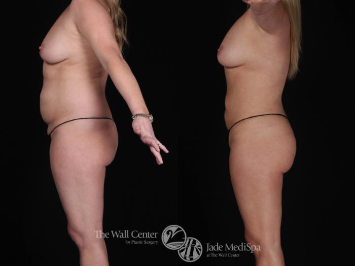 Before & After SAFELipo™ Case 453 View #3 View in Shreveport, LA