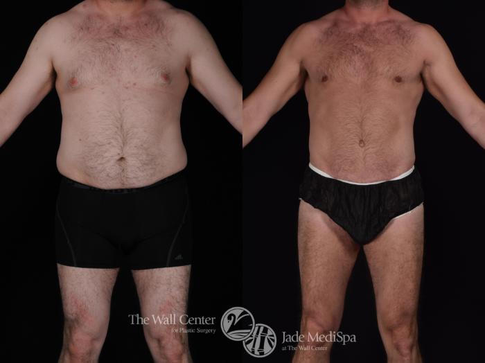 Before & After Male Breast Reduction Case 566 View #1 View in Shreveport, LA
