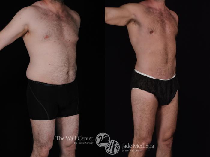 Before & After Male Breast Reduction Case 566 View #2 View in Shreveport, LA