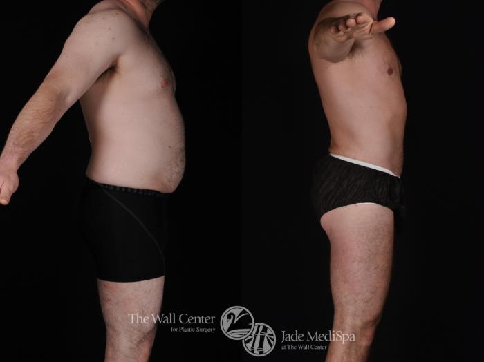 Before & After Male Breast Reduction Case 566 View #3 View in Shreveport, LA