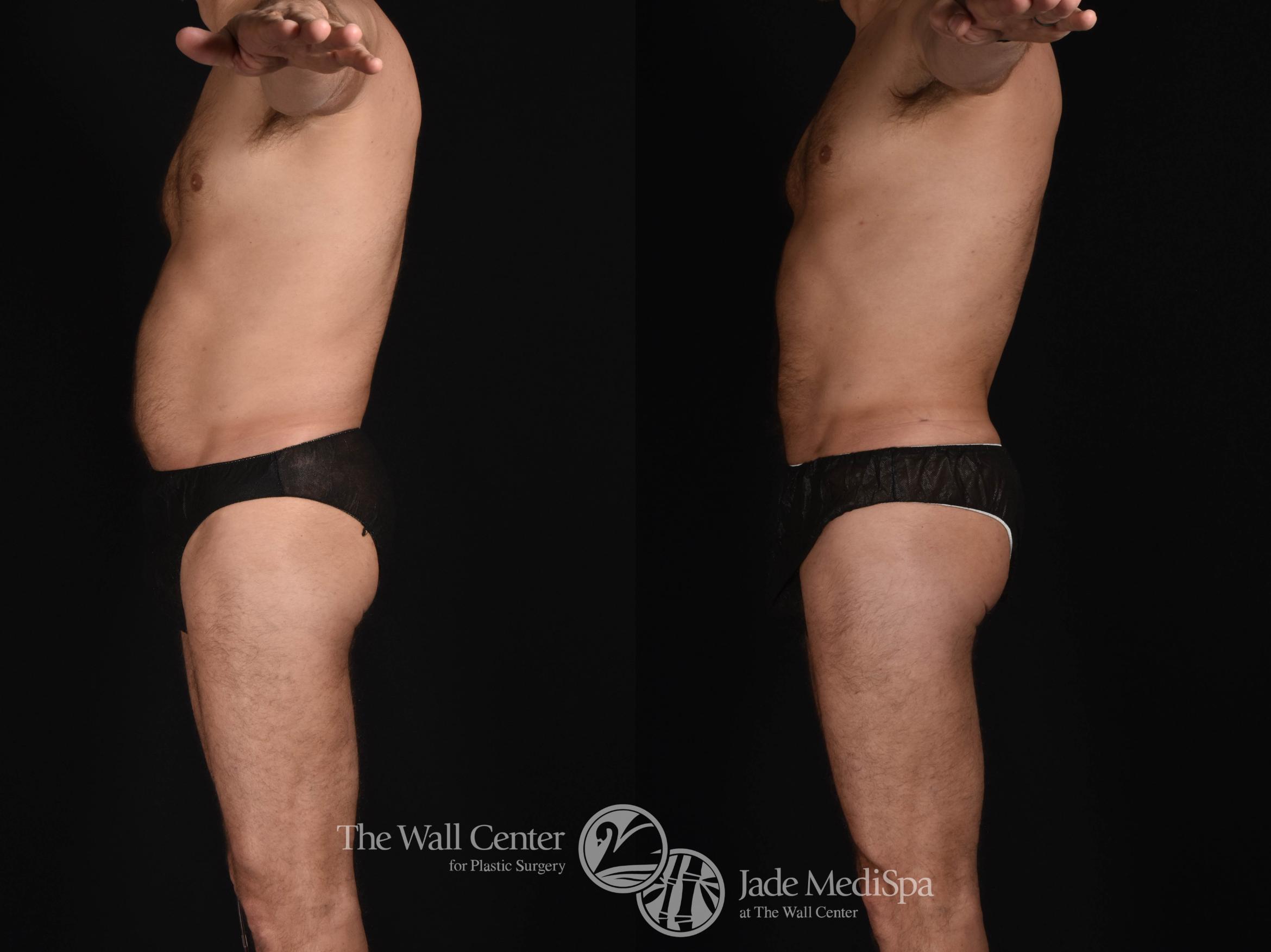 SAFELipo Abdomen Left Side Photo, Shreveport, Louisiana, The Wall Center for Plastic Surgery, Case 826