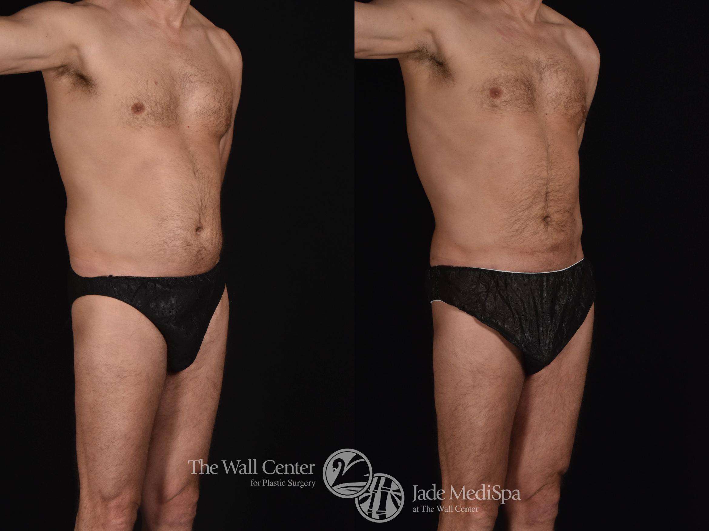 SAFELipo Abdomen Right Oblique Photo, Shreveport, Louisiana, The Wall Center for Plastic Surgery, Case 826