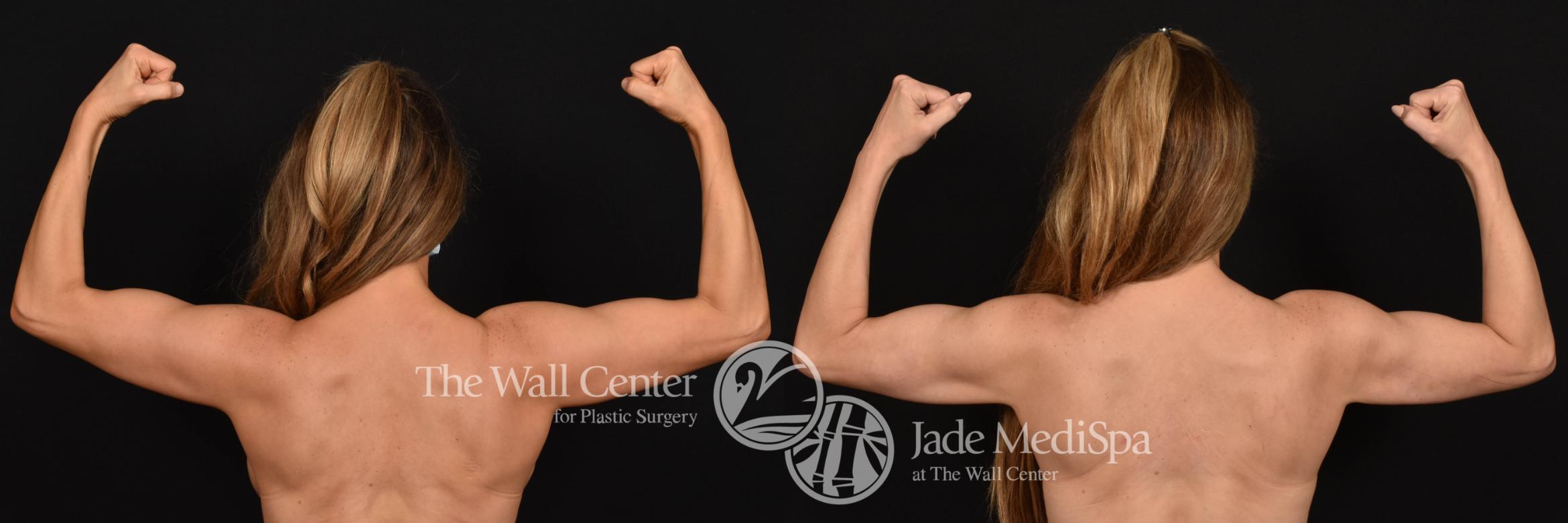 SAFELipo Back Flexed Photo, Shreveport, Louisiana, The Wall Center for Plastic Surgery, Case 917