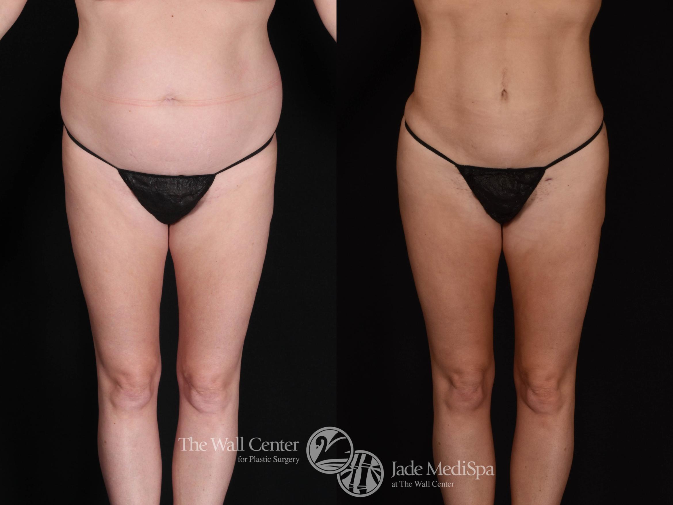 SAFELipo with Fat Grafting to Buttocks Front Photo, Shreveport, Louisiana, The Wall Center for Plastic Surgery, Case 930