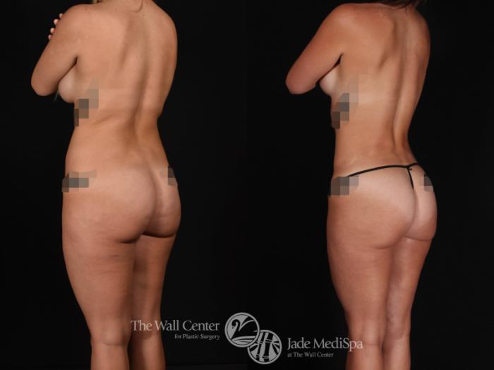 SAFELipo with Fat Grafting to Buttocks Beck Left Oblique Photo, Shreveport, Louisiana, The Wall Center for Plastic Surgery, Case 940